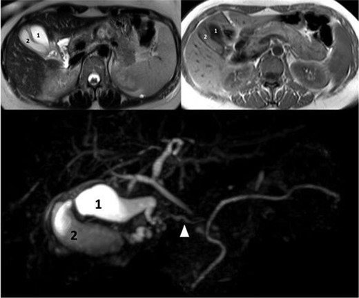 MRI with T2-weighted, T1-weighted images and MRCP showing two distinct gallbladders and one main cystic duct (arrowhead).