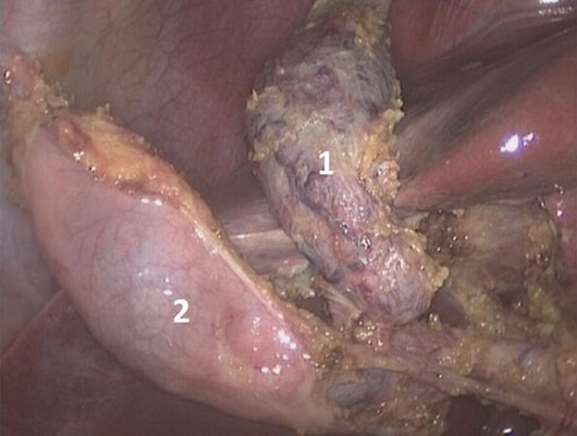 Laparoscopic dissection of the double gallbladder.