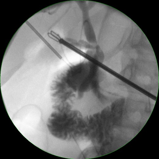 Intraoperative cholangiography.