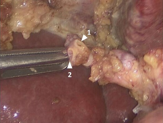 Laparoscopic view showing two separate cystic ducts joining to form one main cystic duct, with a clip on it.