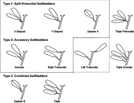 Harlaftis et al. classification for accessory gallbladder.