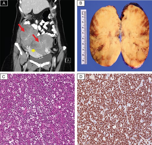 (A) CT scan with contrast revealed large bilateral lobulated heterogeneous adnexal masses (red arrows), displacing the uterus down (arrow head). (B) Gross photo showing homogenous white tan cut surface, focal areas of hemorrhage and necrosis are seen. (C) Histopathology examination demonstrates sheets of diffuse lymphoid infiltrate with prominent starry-sky appearance (H&E; ×20). (D) Ki67 proliferative index is almost 100% (×20).
