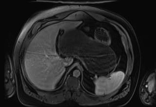 MRI imaging showing a cystic mass located between gastric antrum, pancreas, spleen and hepatic hilum.