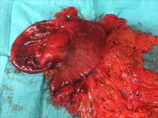 GDC Surgical piece:the GDC attached to the stomach and the omentum.