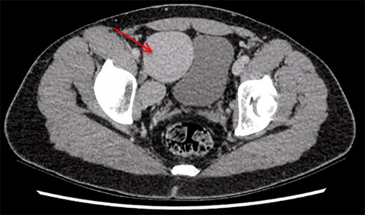 CT scan demonstrating right iliac vein aneurysm (5.7 cm) (red arrow) compressing the patient’s full bladder.