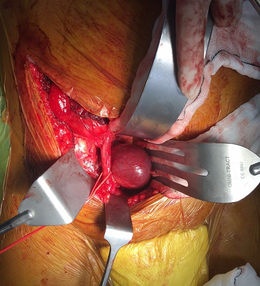 Intra-operative appearance of the external iliac vein aneurysm. A retroperitoneal approach was used via a Rutherford-Morrison incision. Laterally, the external iliac artery is controlled with a vessel loop.