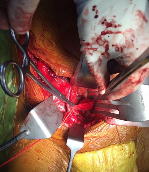 Clamped external iliac vein aneurysm.