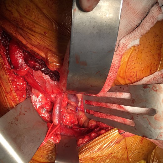 Intra-operative appearance post aneurysmectomy.