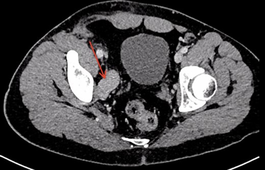 Post-operative CT scan demonstrating no evidence of residual aneurysm, or bladder compression. A residual dilated and tortuous collateral vessel remains communicating between the right internal iliac vein and right common femoral vein (red arrow).