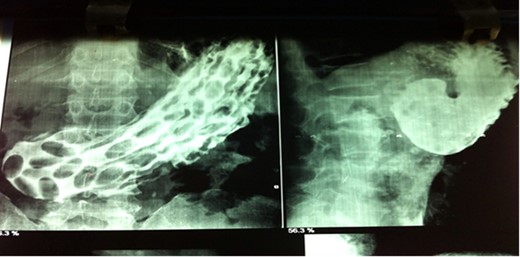 BMFT Film, reported multiple hyperplastic polyps with GOO.