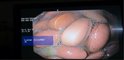 UGI endoscopy showing multiple pills.
