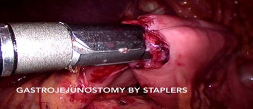 Gastrojejunostomy by endostaplers.