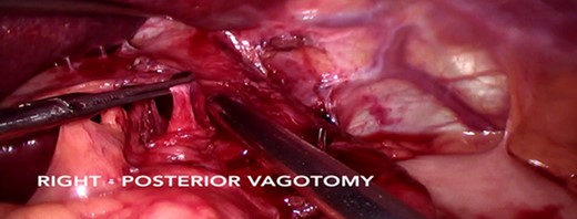 Left and right truncal vagotomy.