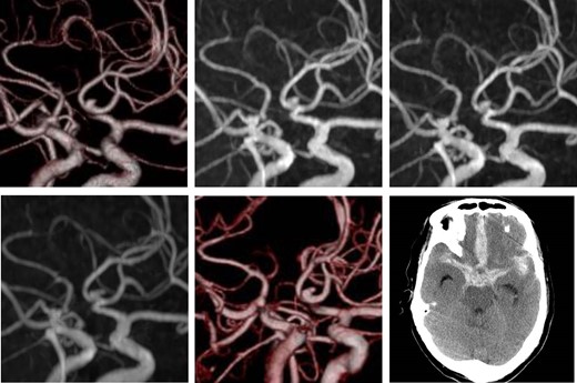 Initial computed tomography angiogram of the unruptured cerebral aneurysm. A saccular aneurysm, 2.7 × 2.1 mm2 in size, is arising from the anterior communicating artery (upper-left). Follow-up magnetic resonance angiography. Images at 6 months (upper-middle) and 1 year (upper-right) after the initial diagnosis show the unchanged aneurysm. Two years after diagnosis, the shape of the aneurysm changed (lower-left). Computed tomography angiogram shows a de novo bleb (lower-middle). Computed tomography after the aneurysm rupture indicates aSAH (lower-right).
