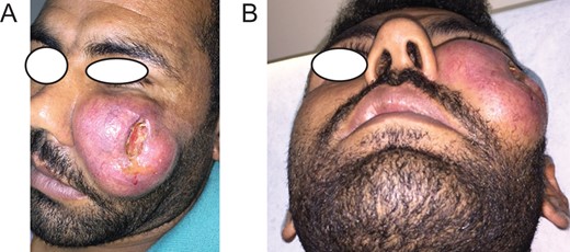 (A and B) A large protuberant mass located at the left side of the face of a 30-year-old Syrian refugee with skin laceration at the middle of the lesion.