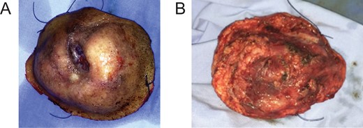 En bloc excision. Macroscopic appearance of the surgical specimen is that of a large tumor (10 × 8 × 4 cm3). (A) From outside view. (B) From inside view.