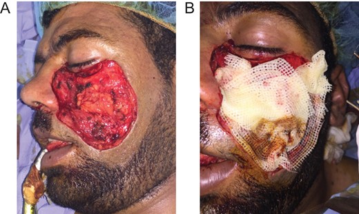 (A) Postoperative defect in the left cheek region. Bone exposure is well noticed. (B) The surgical field with a wound dress (16 June 2015).