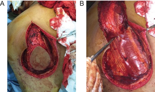 (A) Marking of the LTMC pedicle flap planning on the back. (B) Elevated flap as a distant pedicle flap. (30 June 2015).