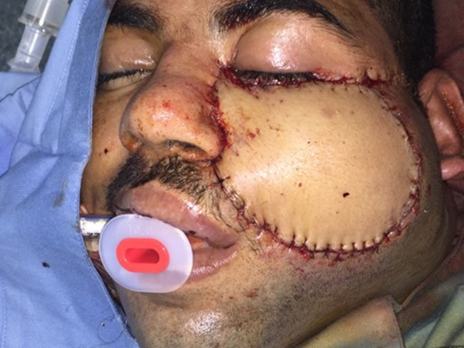 The LTMC pedicle flap was completely covered the postsurgical defect (30 June 2015).