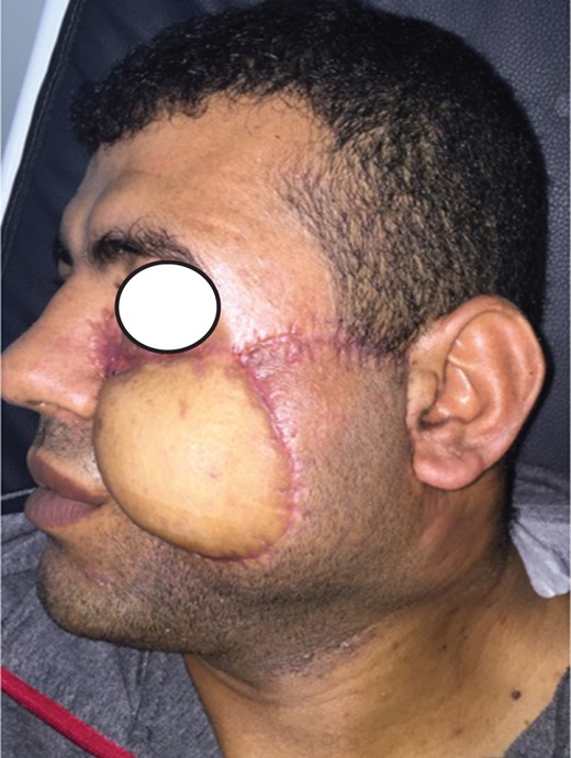 Postoperative view of the well healed LTMC distant pedicle flap. Note the slightly depressed of the left lower eyelid (12 August 2015).