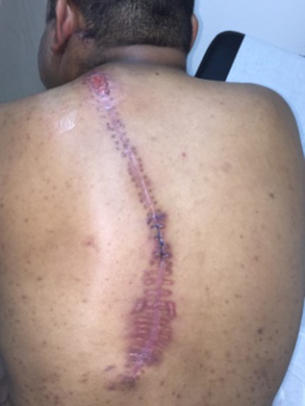 Completely healed state of the donor site with secondary intention for 2 months.