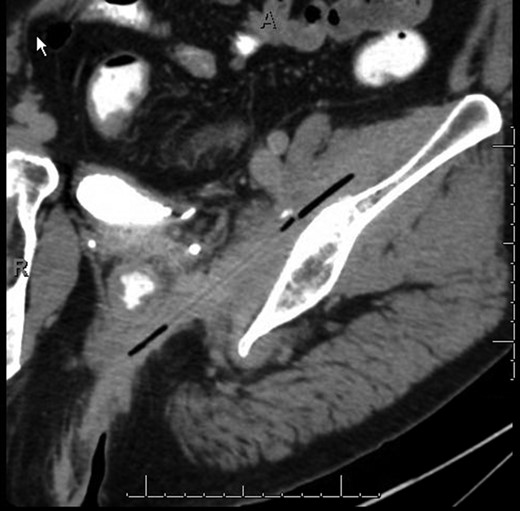 CT image of a linear, partially gas-filled tract starting dorsal to the distal rectum and extending obliquely cephalad and leftward through the obturator internus and iliopsoas musculature.