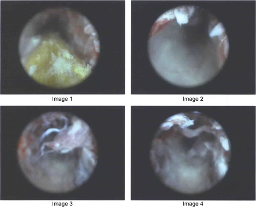 Images from cystoscope showing the retrieval of fibrous object.