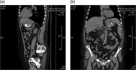 CT abdomen prior to laparoscopic gastric band removal (a) sagittal and (b) coronal.