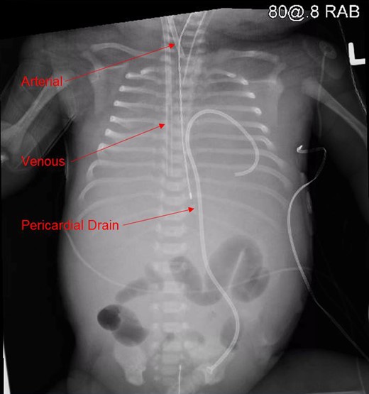 Body X-ray demonstrating pericardial drain, arterial and venous cannulae placement.