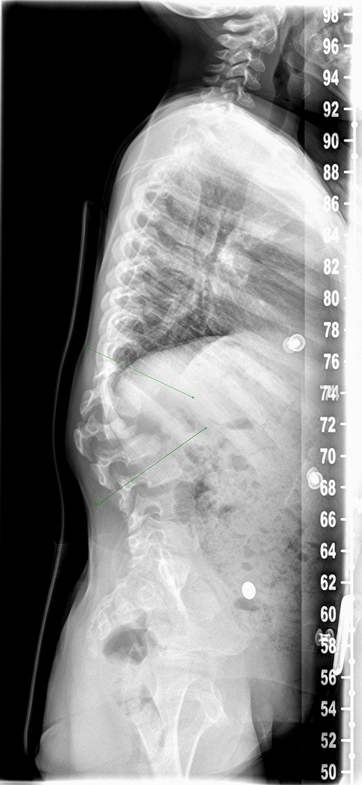 Preoperative spine radiograph.