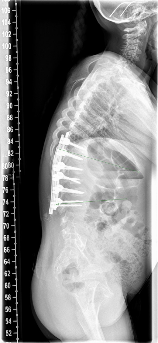 Postoperative spine radiograph.