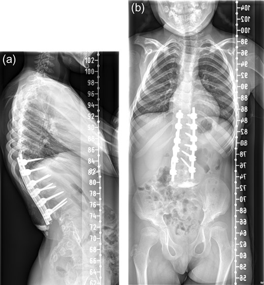 One month postoperative spine radiograph in (a) lateral view and (b) anteroposterior view showing heterotopic ossification.