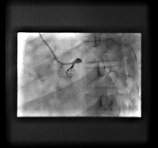 Test shot showing left-main-stem occlusion with dissection (National-Heart-Lung and Blood-Institute class F).