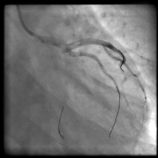 Wires left into the coronaries during transfer. LAD and intermediate: true lumen successfully wired. Cx: unable to wire true lumen.