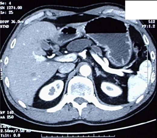 CT-scan, showing a sero-cystic lesion of the pancreatic head without contrast-enhancement, compressing the duodenal lumen and causing a dilation of the Wirsung duct.