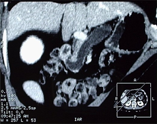 Another image of the CT scan, showing a sero-cystic lesion of the pancreatic head.
