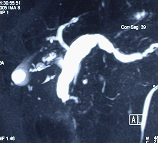Cholangio-MRI, showing an enormously dilated pancreatic duct, with the diameter of 2 cm at the level of the pancreatic body mimicking the sero-cystic lesion found at CT.