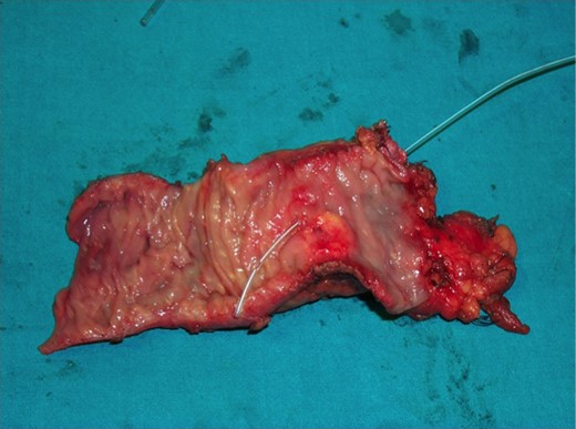 The operative specimen showing a normal thin choledocus (incannulated with a probe) cephalad to the tumor.