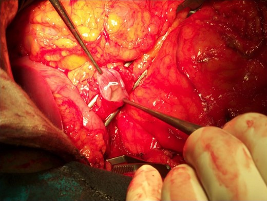 The enormously dilated pancreatic duct (held by the forceps).