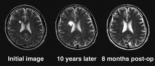 Clinical course of the lesion on follow-up neuroimaging. The tumor increased in size during 10 years of follow-up. No recurrence has been seen as of 8 months postoperatively.
