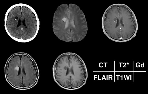 Radiological appearance of the lesion on CT and MRI. The lesion appears as a hypodense cyst with hyperdense nodules in the periventricular region on CT. Both the cystic wall and nodule show signal hypointensity on T2*-weighted images and Gd-enhancement on contrast-enhanced T1-weighted images. The cyst is hyperintense on FLAIR and hypointense on T1-weighted images.