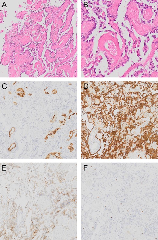 Pathological presentation of the tumor. The pseudopapillary structure comprised hyalinized vessels (A and B) showing positive results for CD34 (C). Small, round cells surrounding these vessels are positive for GFAP (D). Although The neuronal cells between pseudopapillary are loose and hypocellular, in some regions, the synaptophysin-positive neuronal cells are seen in the interpapillary space (E). Ki-67 (MIB-1)-labeling index is 3% (F).