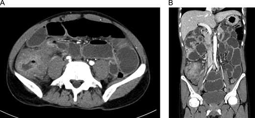(A) and (B) Abdomen CT with IV and oral contrast showed small bowel obstruction secondary to cecal mass.