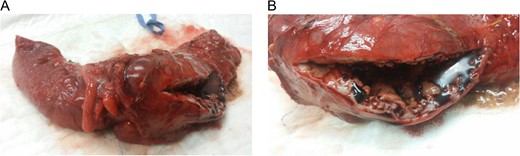 (A) and (B) Resected bowel of a 45-year-old male with an obstructing right-sided colonic mass.