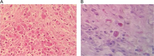 (A) and (B) Slides showing amebic trophozoit ingesting RBC.