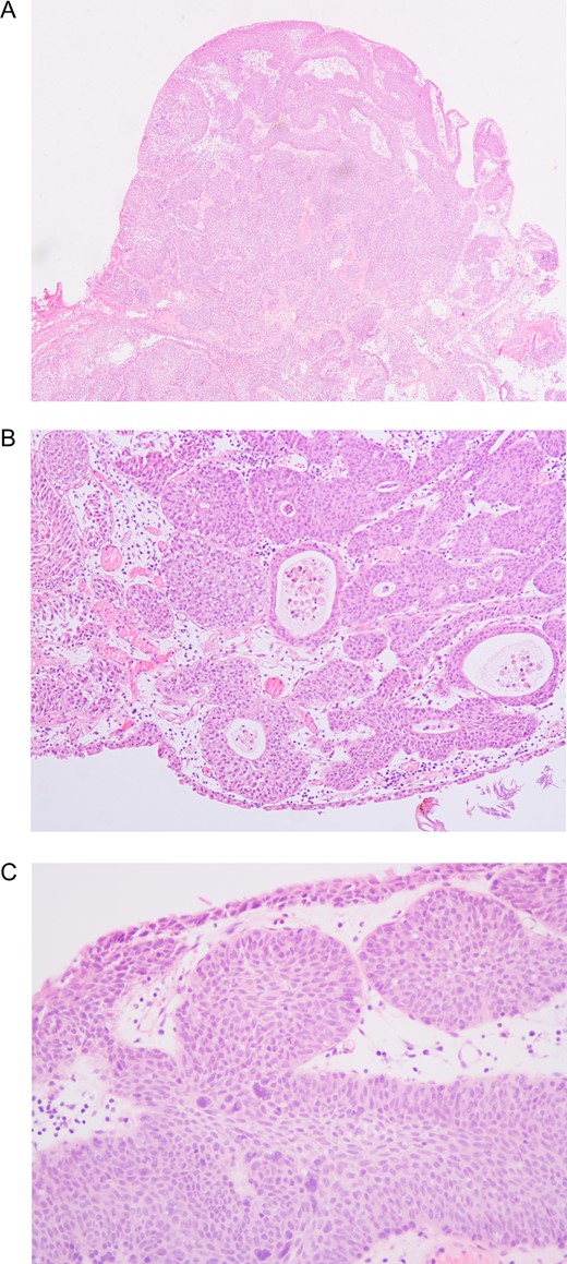 (A) Low magnification showing circumscribed inverted growth pattern with anastomosing nests and trabeculae of urothelial cells just beneath and connected to the smooth surface of benign urothelium (10×). (B) Medium magnification showing occasional microcysts in the inverted urothelial nests (25×). (C) High magnification showing occasional focus of mild epithelial atypia with a degenerative appearance of the nuclei (40×).