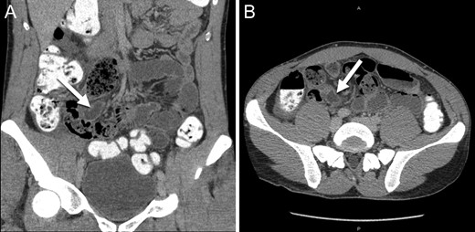 Abdominal CT scan ((A) coronal and (B) axial slices) showing a dilated and inflamed tubular structure indicated by the white arrows misinterpreted as acute appendicitis.