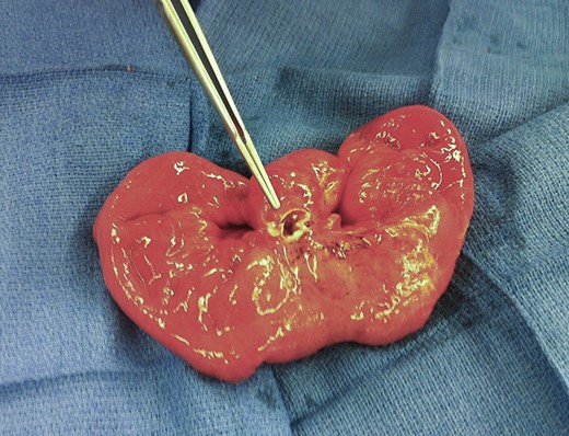 Intra-operative picture of the surgical specimen depicting the mesenteric-sided Meckel’s diverticulum with a clear perforation at the base of the diverticulum.