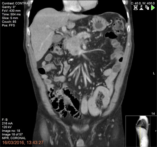 CT scan of the abdomen and pelvis (portal phase) demonstrating a borderline resectable pancreatic tumour at the uncinate process with involvement and complete occlusion of the superior mesenteric vein (SMV) and abutment of the superior mesenteric artery.