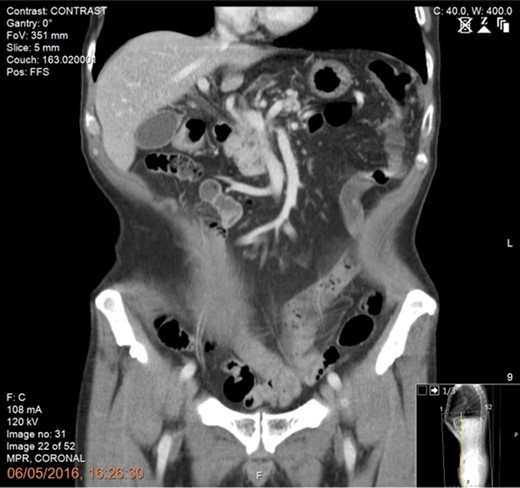 Preoperative CT scan of the abdomen and pelvis (portal phase) showing good response following neoadjuvant chemotherapy with recanalization of the portal vein and no evidence of vascular involvement or distant metastasis.